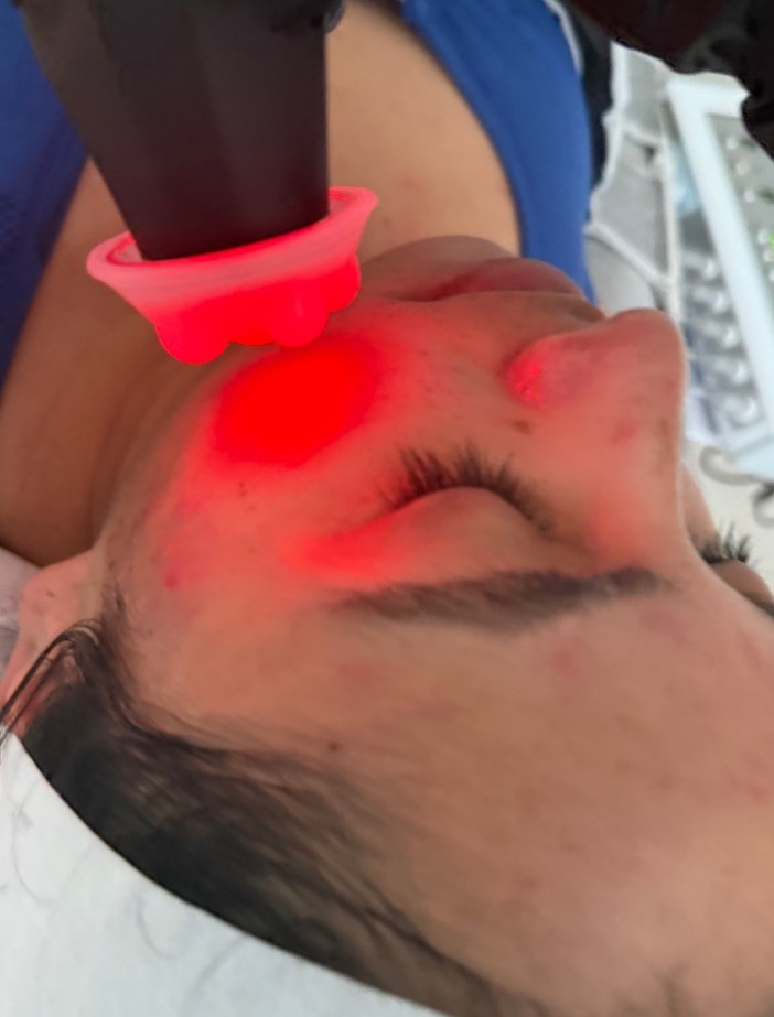 Tratamiento para el Acné con Luz LED